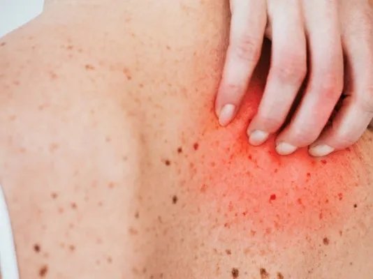 皮肤对金属过敏怎么办