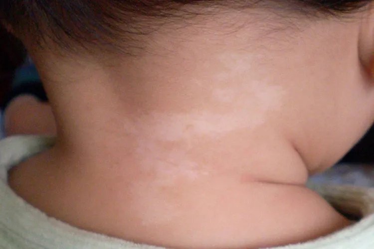 幼儿白斑早期图片大全