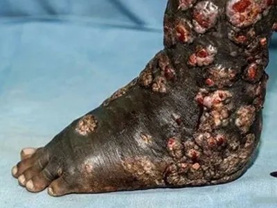 足菌肿症状图片