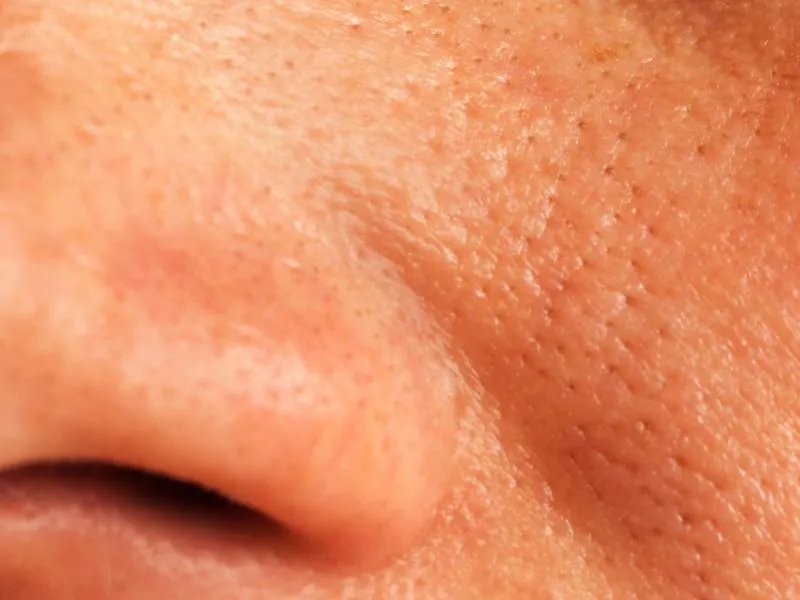 鼻翼两侧长斑原因