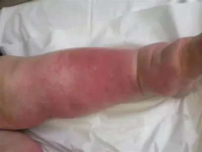 新生儿皮下坏疽症状图片