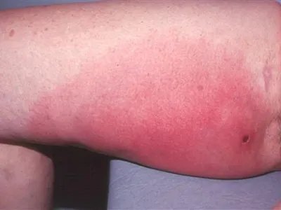 新生儿皮下坏疽症状图片