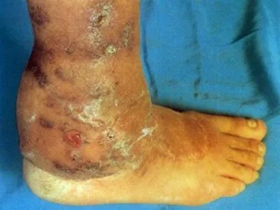 足菌肿症状图片