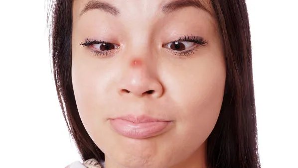 脸上痘印怎么办