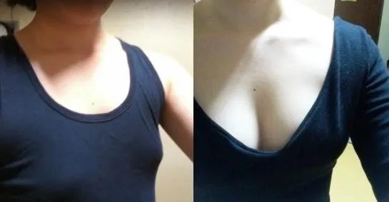 玻尿酸隆胸多少钱呢