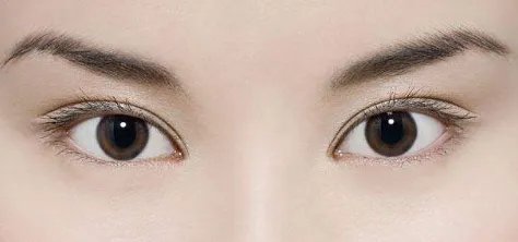 眼部抽脂手术后注意什么