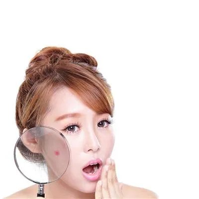 脂溢性痤疮怎么治疗