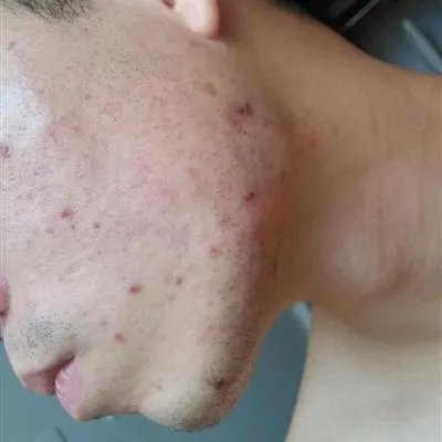 如何让去除青春痘