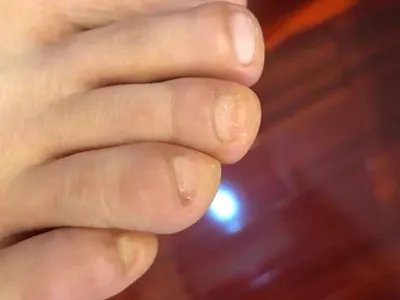 远端侧位甲下型甲真菌病脚趾甲缩小图片