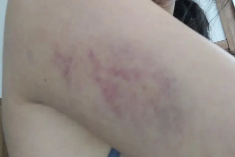 打伤的淤青图片