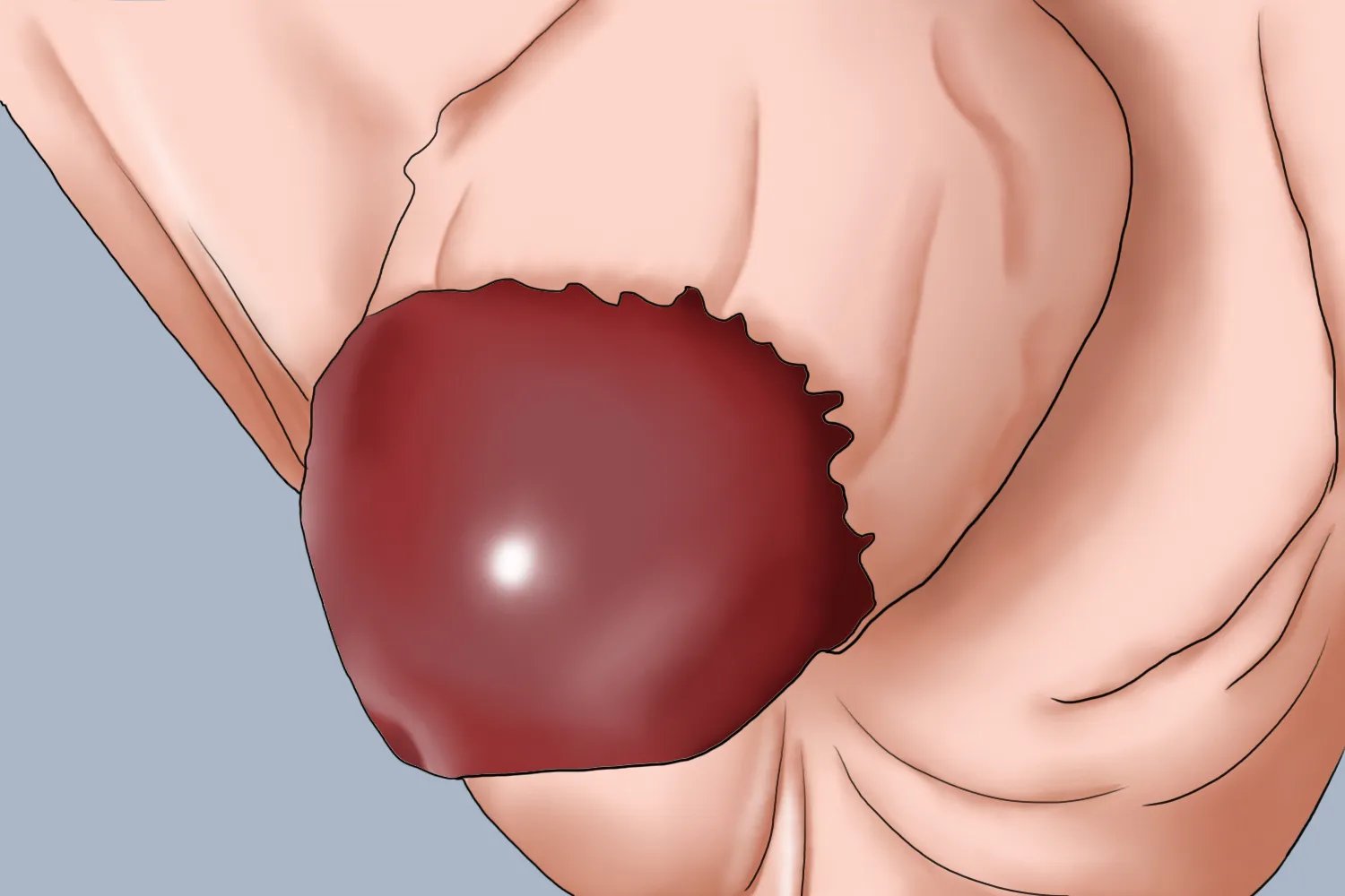 包皮淋巴水肿图片