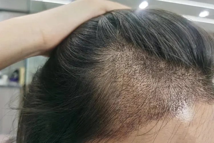 植发恢复过程图片