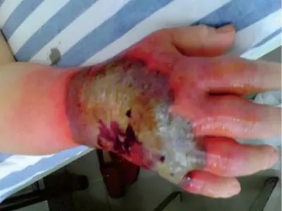 新生儿皮下坏疽症状图片