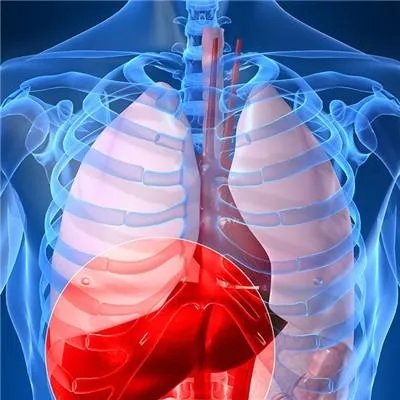 肝硬化肝癌吃什么药好