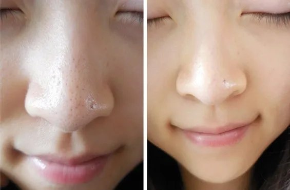 光子嫩肤去黑头效果好不好