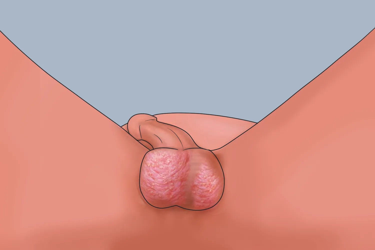 阴囊湿疹皮肤增厚图片