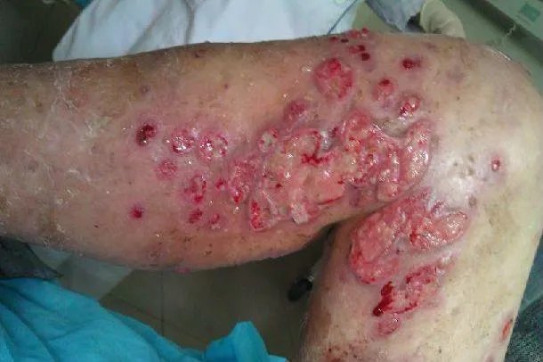 分枝杆菌感染皮肤病图