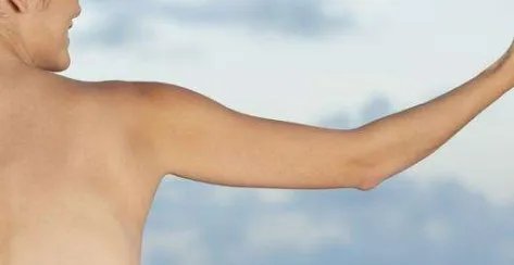 胳膊吸脂注意事项有哪些