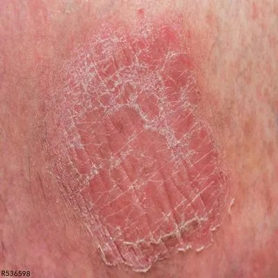 过敏性皮肤病的危害有哪些 揭晓过敏性皮肤病的四个危害