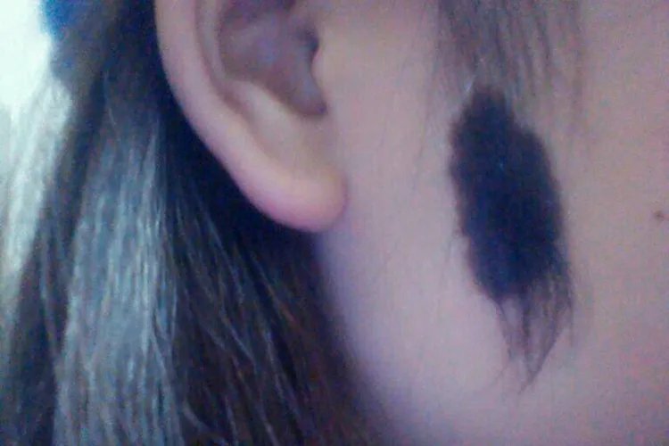 脸上有黑色胎记图片