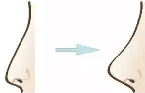 注射隆鼻需要注意哪些事项