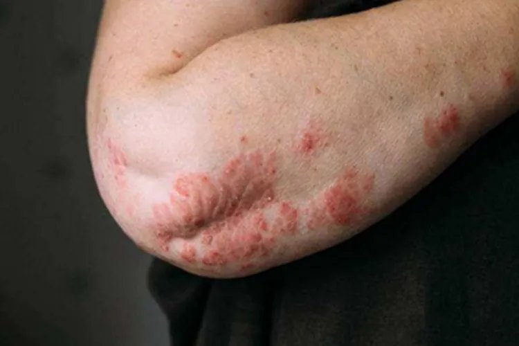 关节病型银屑病症状图片