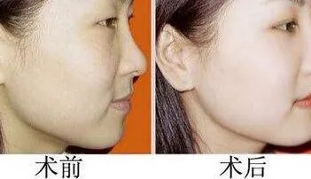 彩光嫩肤的价格是多少