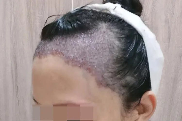 植发恢复过程图片