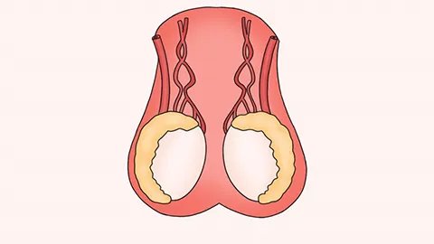 附睾炎好治疗吗