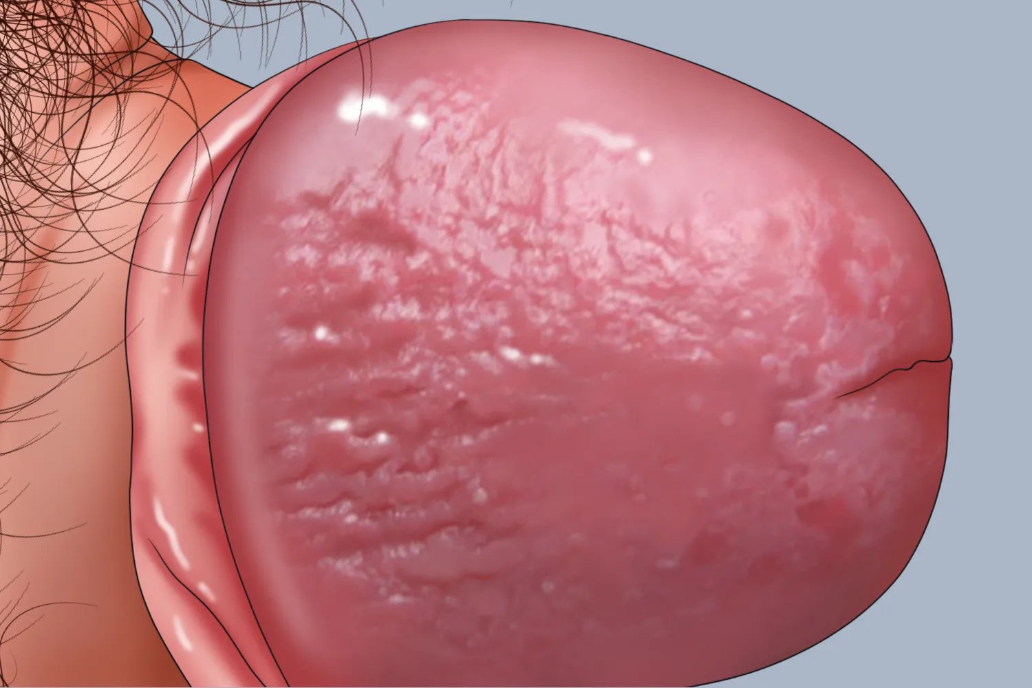 包皮淋巴水肿图片
