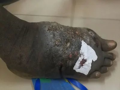 足菌肿症状图片