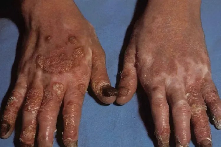 关节病型银屑病症状图片