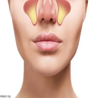 空鼻症有什么症状 空鼻症3症状揭晓