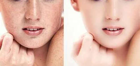 祛斑哪家医院好