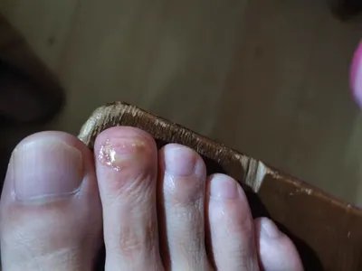 远端侧位甲下型甲真菌病脚趾甲缩小图片