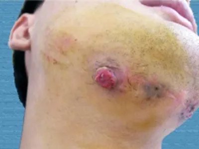 足菌肿症状图片