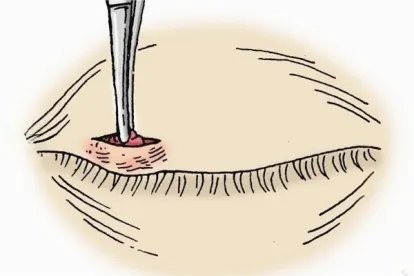 内麦粒肿手术过程图解