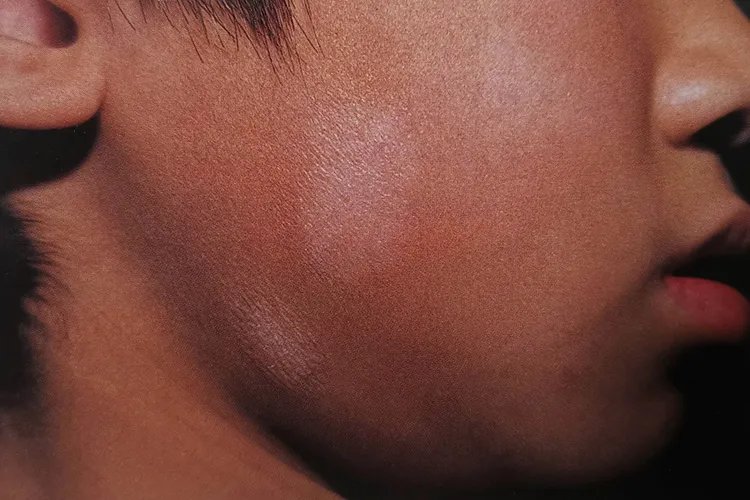 幼儿白斑早期图片大全