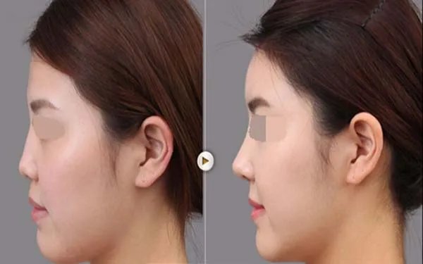 鼻翼整形术多少钱