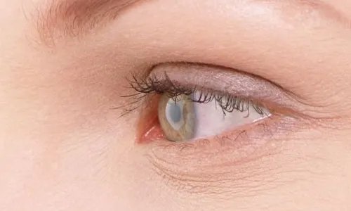 激光割双眼皮怎么样