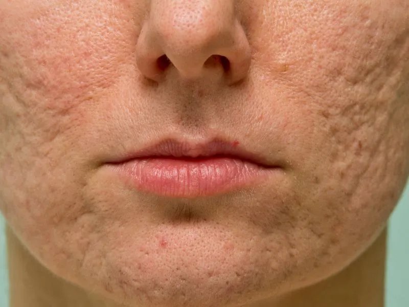 鼻子长黑头怎么办