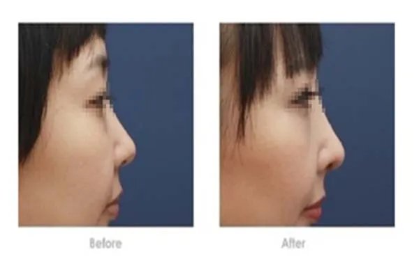 鼻头缩小手术多少钱