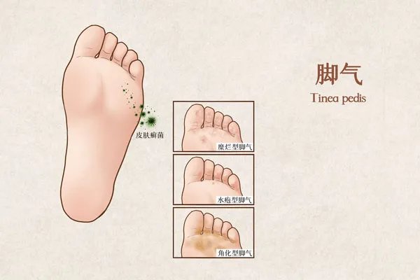 脚底板长水泡很痒是怎么回事
