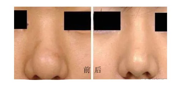 鼻头缩小手术的方法