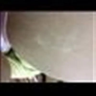 白颠疯怎么样治疗好