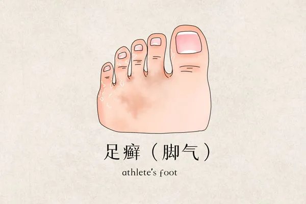 脚底板长水泡很痒是怎么回事