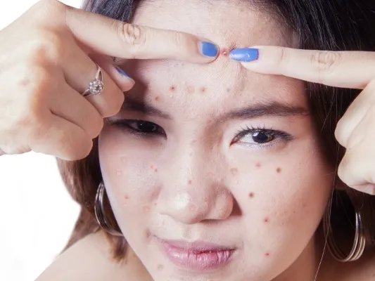 如何减少青春痘