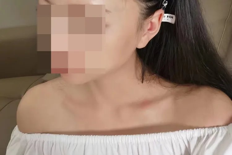 植发恢复过程图片