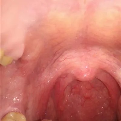 咽喉炎偏方有什么，是否对症！