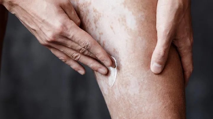 贵阳白癜风医院:白癜风的病因是什么